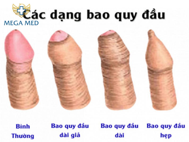 16 tuổi có nên cắt bao quy đầu